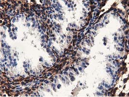 IHC of paraffin-embedded Carcinoma of Human prostate tissue using anti-MICAL1 mouse monoclonal antibody.