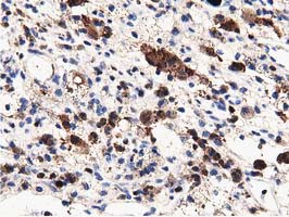 IHC of paraffin-embedded Carcinoma of Human kidney tissue using anti-MICAL1 mouse monoclonal antibody.