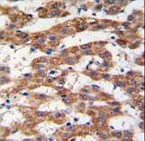 Formalin-fixed and paraffin-embedded human hepatocarcinoma tissue reacted with PHB antibody , which was peroxidase-conjugated to the secondary antibody, followed by DAB staining. This data demonstrates the use of this antibody for immunohistochemistry; clinical relevance has not been evaluated.