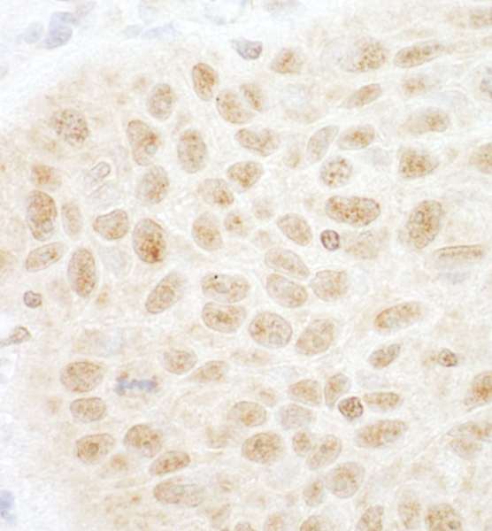 Detection of Human PHF20 by Immunohistochemistry. Sample: FFPE section of human lung carcinoma. Antibody: Affinity purified rabbit anti-PHF20 used at a dilution of 1:1000 (1 ug/ml). Detection: DAB.