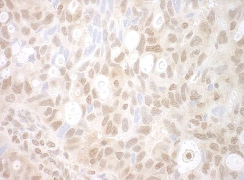 Detection of Human PHF20 by Immunohistochemistry. Sample: FFPE section of human ovarian carcinoma. Antibody: Affinity purified rabbit anti-PHF20 used at a dilution of 1:250.