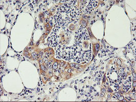 IHC of paraffin-embedded Carcinoma of Human pancreas tissue using anti-PHF21B mouse monoclonal antibody.