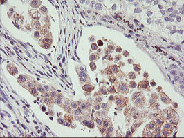 IHC of paraffin-embedded Carcinoma of Human lung tissue using anti-PHF21B mouse monoclonal antibody.
