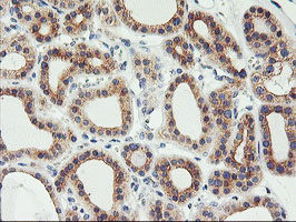 IHC of paraffin-embedded Carcinoma of Human thyroid tissue using anti-PHF21B mouse monoclonal antibody.