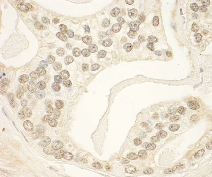 Detection of Human PHF23 by Immunohistochemistry. Sample: FFPE section of human prostate carcinoma. Antibody: Affinity purified rabbit anti-PHF23 used at a dilution of 1:1000 (1 ug/ml). Detection: DAB.