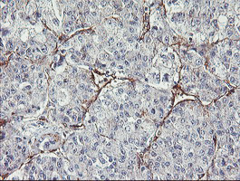 IHC of paraffin-embedded Carcinoma of Human liver tissue using anti-MIER2 mouse monoclonal antibody.