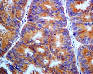 IHC of paraffin-embedded human colonic carcinoma tissue using anti- PHLDA1 antibody.