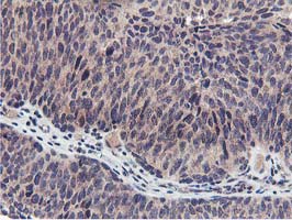 IHC of paraffin-embedded Carcinoma of Human bladder tissue using anti-MIER2 mouse monoclonal antibody. (Heat-induced epitope retrieval by 10mM citric buffer, pH6.0, 100C for 10min).