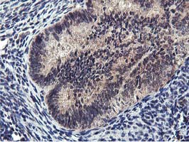 IHC of paraffin-embedded Adenocarcinoma of Human endometrium tissue using anti-MIER2 mouse monoclonal antibody. (Heat-induced epitope retrieval by 10mM citric buffer, pH6.0, 100C for 10min).