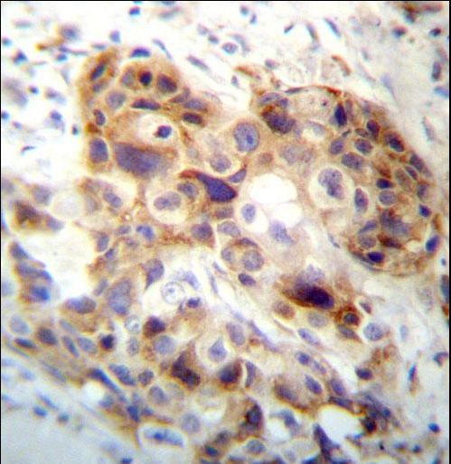 PI15 Antibody immunohistochemistry of formalin-fixed and paraffin-embedded human breast carcinoma followed by peroxidase-conjugated secondary antibody and DAB staining.