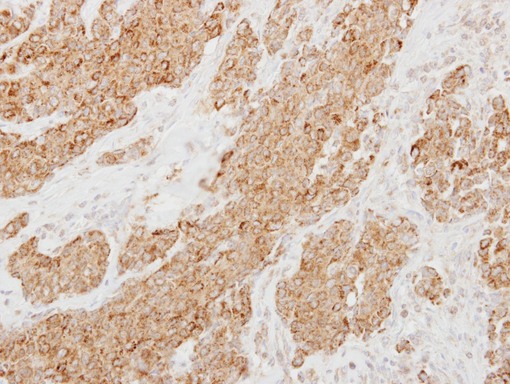 IHC of paraffin-embedded Breast ca using Protease Inhibitor 15 antibody at 1:250 dilution.