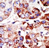 Formalin-fixed and paraffin-embedded human cancer tissue reacted with the primary antibody, which was peroxidase-conjugated to the secondary antibody, followed by DAB staining. This data demonstrates the use of this antibody for immunohistochemistry; clinical relevance has not been evaluated. BC = breast carcinoma; HC = hepatocarcinoma.