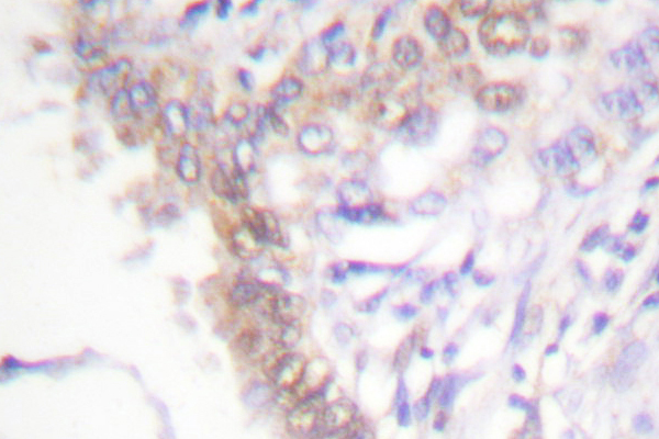 IHC of PIAS3 (F25) pAb in paraffin-embedded human lung carcinoma tissue.