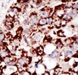 Formalin-fixed and paraffin-embedded human cancer tissue reacted with the primary antibody, which was peroxidase-conjugated to the secondary antibody, followed by DAB staining. This data demonstrates the use of this antibody for immunohistochemistry; clinical relevance has not been evaluated. BC = breast carcinoma; HC = hepatocarcinoma.