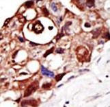 Formalin-fixed and paraffin-embedded human cancer tissue reacted with the primary antibody, which was peroxidase-conjugated to the secondary antibody, followed by DAB staining. This data demonstrates the use of this antibody for immunohistochemistry; clinical relevance has not been evaluated. BC = breast carcinoma; HC = hepatocarcinoma.