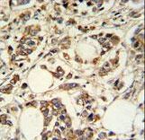 PIGM Antibody IHC of formalin-fixed and paraffin-embedded breast carcinoma followed by peroxidase-conjugated secondary antibody and DAB staining.