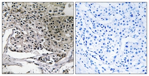 IHC of paraffin-embedded human breast carcinoma tissue, using PIGY Antibody. The picture on the right is treated with the synthesized peptide.