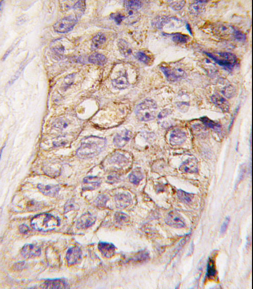 Formalin-fixed and paraffin-embedded human breast carcinoma tissue reacted with PI3KC2B antibody , which was peroxidase-conjugated to the secondary antibody, followed by DAB staining. This data demonstrates the use of this antibody for immunohistochemistry; clinical relevance has not been evaluated.