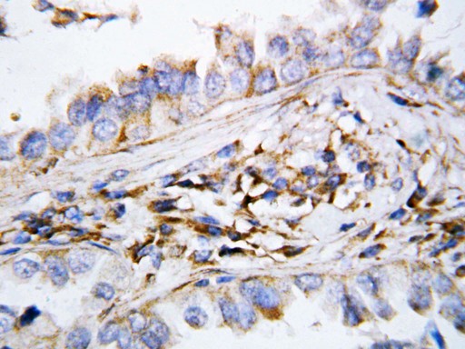 MIG / CXCL9 antibody. IHC(P): Human Lung Cancer Tissue.