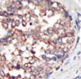 Formalin-fixed and paraffin-embedded human cancer tissue reacted with the primary antibody, which was peroxidase-conjugated to the secondary antibody, followed by AEC staining. This data demonstrates the use of this antibody for immunohistochemistry; clinical relevance has not been evaluated. BC = breast carcinoma; HC = hepatocarcinoma.