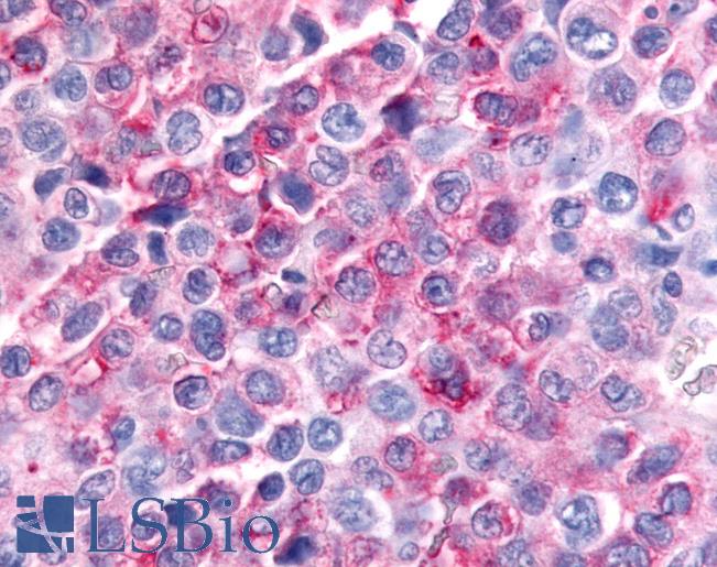 Anti-MINK1 / MINK antibody IHC of human Lymph Node, Non-Hodgkins Lymphoma. Immunohistochemistry of formalin-fixed, paraffin-embedded tissue after heat-induced antigen retrieval.