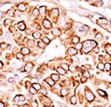 Formalin-fixed and paraffin-embedded human cancer tissue reacted with the primary antibody, which was peroxidase-conjugated to the secondary antibody, followed by AEC staining. This data demonstrates the use of this antibody for immunohistochemistry; clinical relevance has not been evaluated. BC = breast carcinoma; HC = hepatocarcinoma.