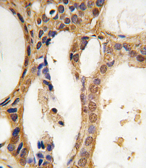 Formalin-fixed and paraffin-embedded human prostate carcinoma tissue reacted with PIM1 antibody, which was peroxidase-conjugated to the secondary antibody, followed by DAB staining. This data demonstrates the use of this antibody for immunohistochemistry; clinical relevance has not been evaluated.