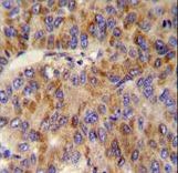 MINPP1 Antibody immunohistochemistry of formalin-fixed and paraffin-embedded human hepatocarcinoma followed by peroxidase-conjugated secondary antibody and DAB staining.