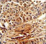 Formalin-fixed and paraffin-embedded human lung carcinoma reacted with PIN1 Antibody , which was peroxidase-conjugated to the secondary antibody, followed by DAB staining. This data demonstrates the use of this antibody for immunohistochemistry; clinical relevance has not been evaluated.