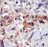 Formalin-fixed and paraffin-embedded human cancer tissue reacted with the primary antibody, which was peroxidase-conjugated to the secondary antibody, followed by AEC staining. This data demonstrates the use of this antibody for immunohistochemistry; clinical relevance has not been evaluated. BC = breast carcinoma; HC = hepatocarcinoma.