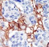 Formalin-fixed and paraffin-embedded human cancer tissue reacted with the primary antibody, which was peroxidase-conjugated to the secondary antibody, followed by AEC staining. This data demonstrates the use of this antibody for immunohistochemistry; clinical relevance has not been evaluated. BC = breast carcinoma; HC = hepatocarcinoma.