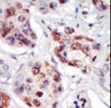Formalin-fixed and paraffin-embedded human cancer tissue reacted with the primary antibody, which was peroxidase-conjugated to the secondary antibody, followed by AEC staining. This data demonstrates the use of this antibody for immunohistochemistry; clinical relevance has not been evaluated. BC = breast carcinoma; HC = hepatocarcinoma.