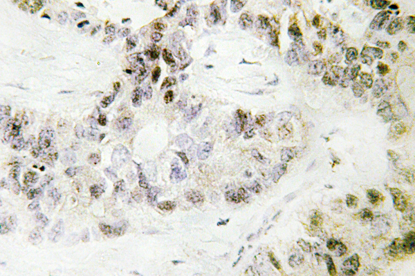 IHC of Pitx1 (E130) pAb in paraffin-embedded human lung carcinoma tissue.