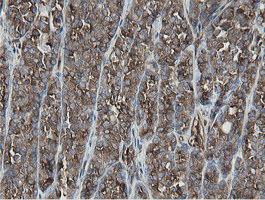 IHC of paraffin-embedded Carcinoma of Human thyroid tissue using anti-MIPEP mouse monoclonal antibody.