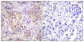 IHC of paraffin-embedded human breast carcinoma, using PKC-pan (Phospho-Thr497) Antibody. The sample on the right was incubated with synthetic peptide.