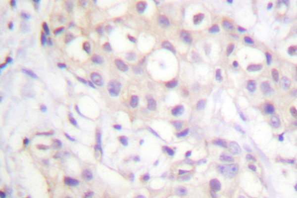 IHC of PKC-pan (T495) pAb in paraffin-embedded human breast carcinoma tissue.