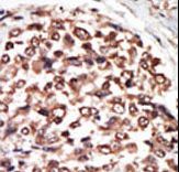 Formalin-fixed and paraffin-embedded human cancer tissue reacted with the primary antibody, which was peroxidase-conjugated to the secondary antibody, followed by AEC staining. This data demonstrates the use of this antibody for immunohistochemistry; clinical relevance has not been evaluated. BC = breast carcinoma; HC = hepatocarcinoma.