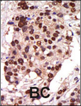 Formalin-fixed and paraffin-embedded human cancer tissue reacted with the primary antibody, which was peroxidase-conjugated to the secondary antibody, followed by AEC staining. This data demonstrates the use of this antibody for immunohistochemistry; clinical relevance has not been evaluated. BC = breast carcinoma; HC = hepatocarcinoma.