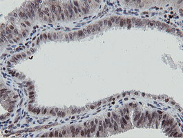 IHC of paraffin-embedded Adenocarcinoma of Human endometrium tissue using anti-MIPEP mouse monoclonal antibody.