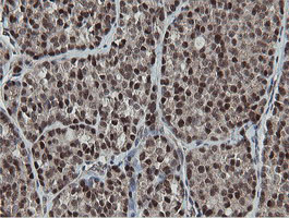 IHC of paraffin-embedded Carcinoma of Human thyroid tissue using anti-MIPEP mouse monoclonal antibody.