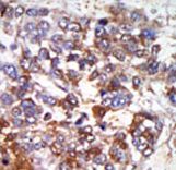 Formalin-fixed and paraffin-embedded human cancer tissue reacted with the primary antibody, which was peroxidase-conjugated to the secondary antibody, followed by AEC staining. This data demonstrates the use of this antibody for immunohistochemistry; clinical relevance has not been evaluated. BC = breast carcinoma; HC = hepatocarcinoma.