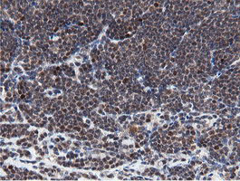 IHC of paraffin-embedded Human lymphoma tissue using anti-MIPEP mouse monoclonal antibody.