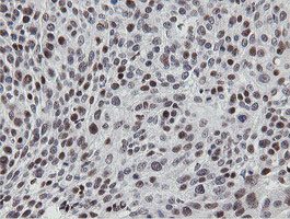 IHC of paraffin-embedded Carcinoma of Human bladder tissue using anti-MIPEP mouse monoclonal antibody.