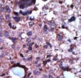 Formalin-fixed and paraffin-embedded human cancer tissue reacted with the primary antibody, which was peroxidase-conjugated to the secondary antibody, followed by AEC staining. This data demonstrates the use of this antibody for immunohistochemistry; clinical relevance has not been evaluated. BC = breast carcinoma; HC = hepatocarcinoma.