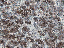 IHC of paraffin-embedded Carcinoma of Human liver tissue using anti-MIPEP mouse monoclonal antibody.
