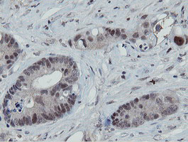 IHC of paraffin-embedded Adenocarcinoma of Human colon tissue using anti-MIPEP mouse monoclonal antibody.