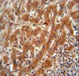 Pyruvate Kinase (PKM2) Antibody immunohistochemistry of formalin-fixed and paraffin-embedded human hepatocarcinoma followed by peroxidase-conjugated secondary antibody and DAB staining. This data demonstrates the use of the Pyruvate Kinase (PKM2) Antibody for immunohistochemistry.