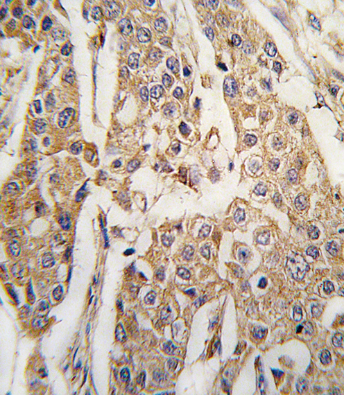 Formalin-fixed and paraffin-embedded human breast carcinoma tissue reacted with PKM2 antibody (C-term C474) , which was peroxidase-conjugated to the secondary antibody, followed by DAB staining. This data demonstrates the use of this antibody for immunohistochemistry; clinical relevance has not been evaluated.