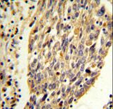 PKM2 (N-term E131) Antibody IHC of formalin-fixed and paraffin-embedded human lung carcinoma followed by peroxidase-conjugated secondary antibody and DAB staining. This data demonstrates the use of the PKM2 (N-term E131) Antibody for immunohistochemistry.