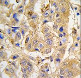 Formalin-fixed and paraffin-embedded human breast carcinoma tissue reacted with MIPEP antibody , which was peroxidase-conjugated to the secondary antibody, followed by DAB staining. This data demonstrates the use of this antibody for immunohistochemistry; clinical relevance has not been evaluated.